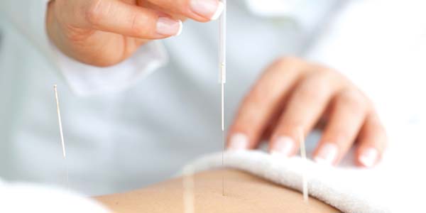 acupuntura